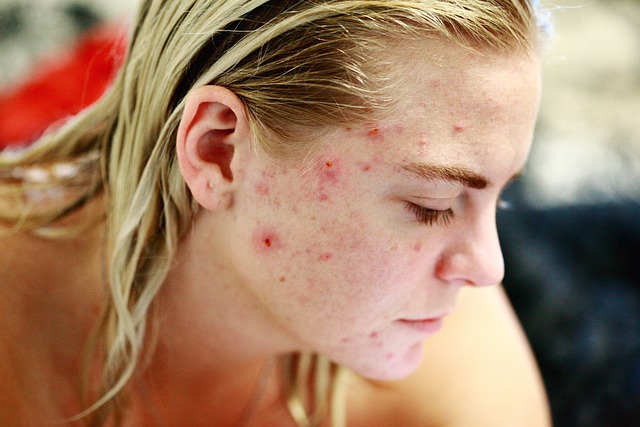 pelle con acne